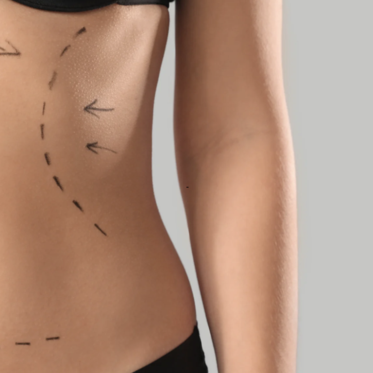 Liposuction Recovery and Results Timeline
